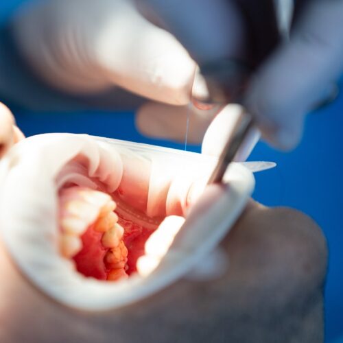 surgical tooth extraction-min